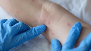 Vaiolo delle scimmie che cos'è, come si cura e cosa provoca?