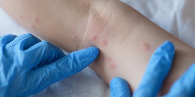 Vaiolo delle scimmie che cos'è, come si cura e cosa provoca?