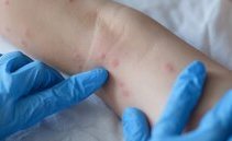 Vaiolo delle scimmie primo morto in Italia e in Svizzera cresce la preoccupazione